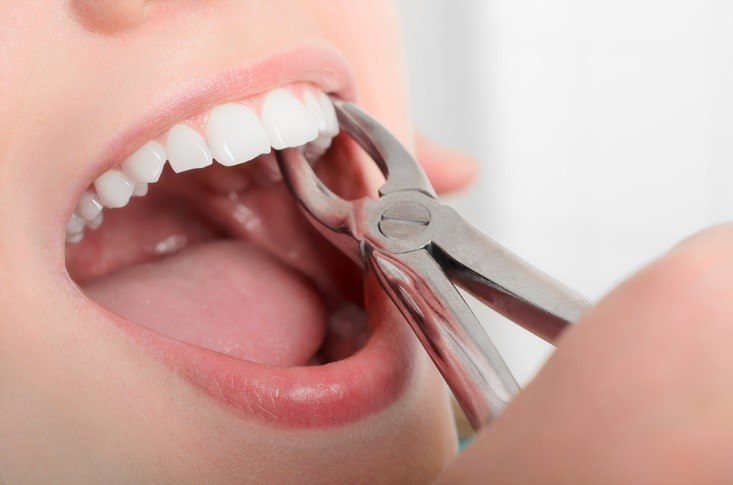 Root Canal